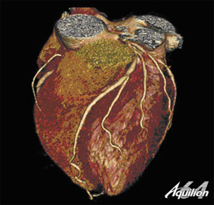 Image of Heart from 64 Slice CT Scanner
