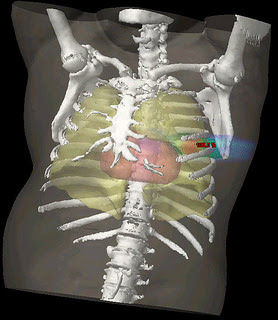 Stereotactic Lung Case Image