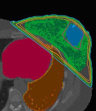 Targeting of a breast tumor (depicted in blue). Courtesy Jinsheng Li