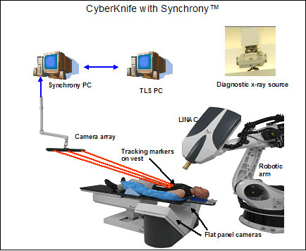 Cyberknife with Synchrony