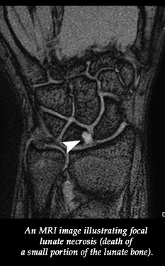 An MRI image illustrating focal lunatic necrosis (death of a small portion of the lunate bone).